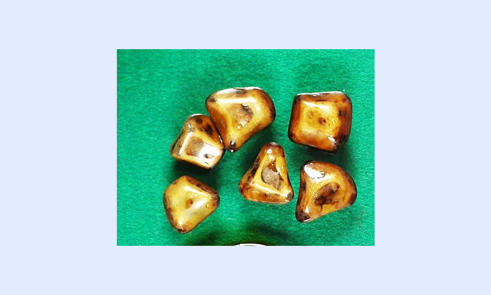 コレステロール胆石