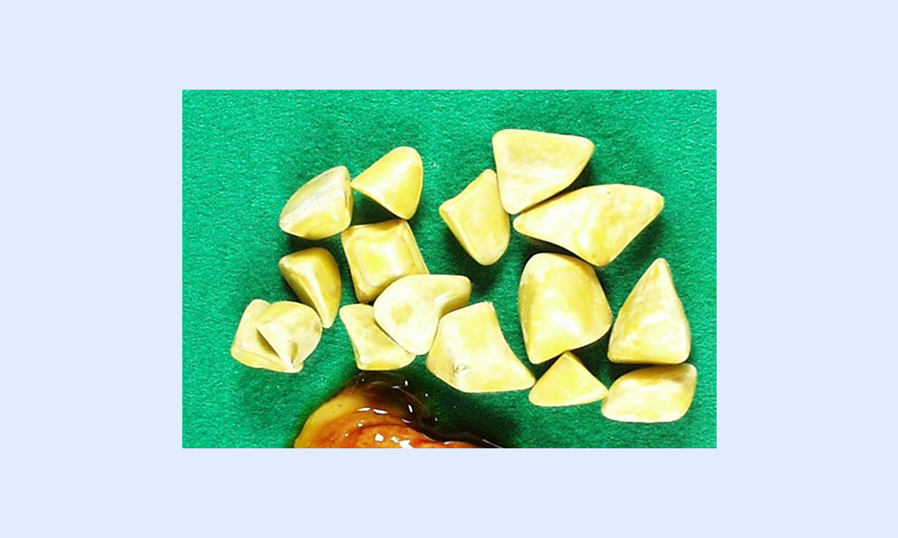 コレステロール胆石