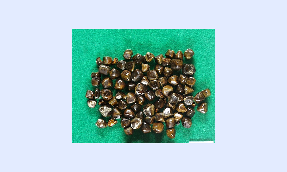 コレステロール胆石