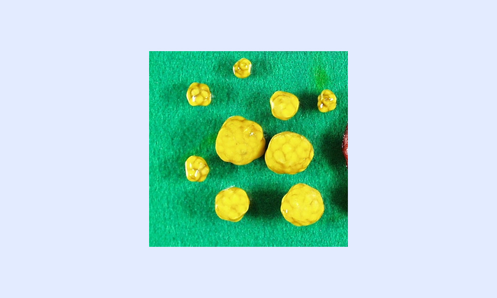 コレステロール胆石