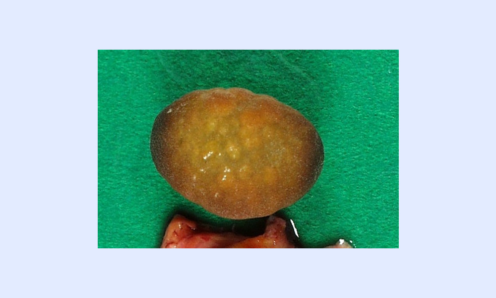 コレステロール胆石