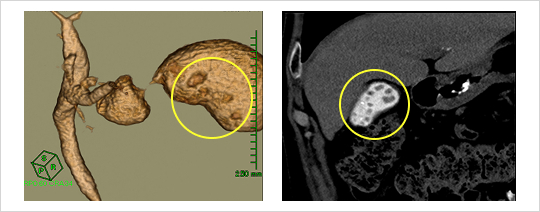 DIC（点滴静注胆道（胆のう）造影）