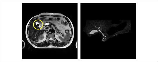 MRCP（磁気共鳴胆道膵管造影）